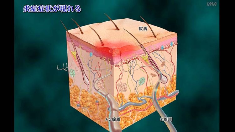Chapter-2 痛みと炎症